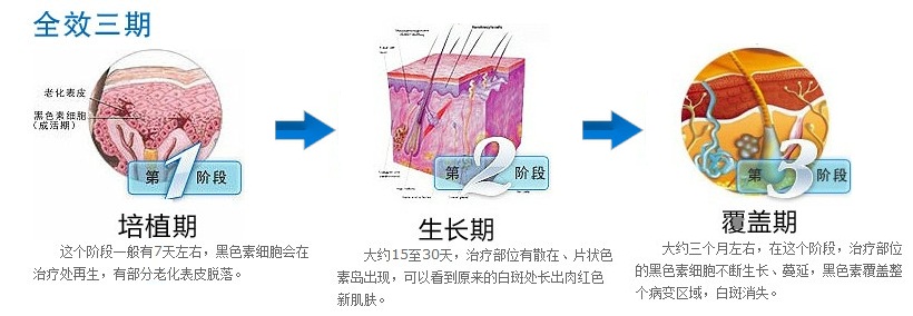 黑色素细胞培植术全效三期