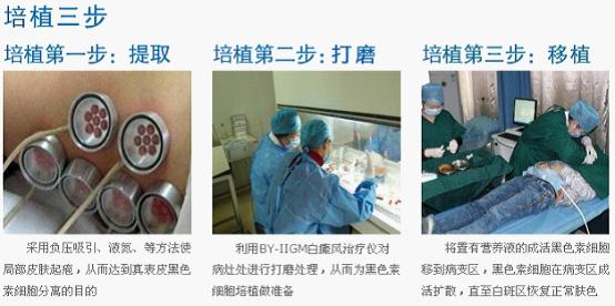 白癜风消失全过程